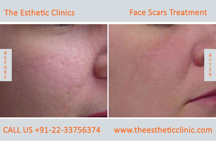 Face Scar Removal Laser Treatment before after photos in mumbai india (6)
